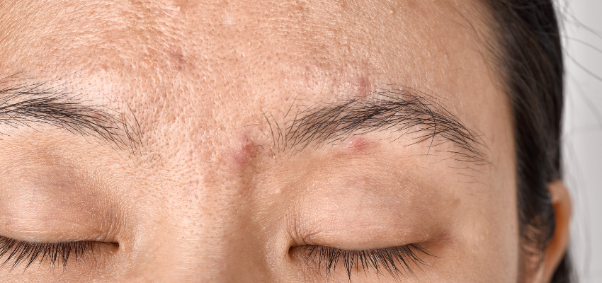 A woman with severe acne.